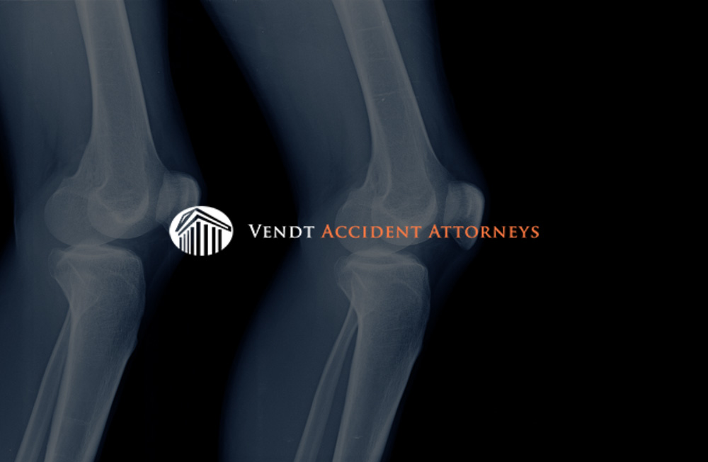 Richmond soft tissue injury attorney near me