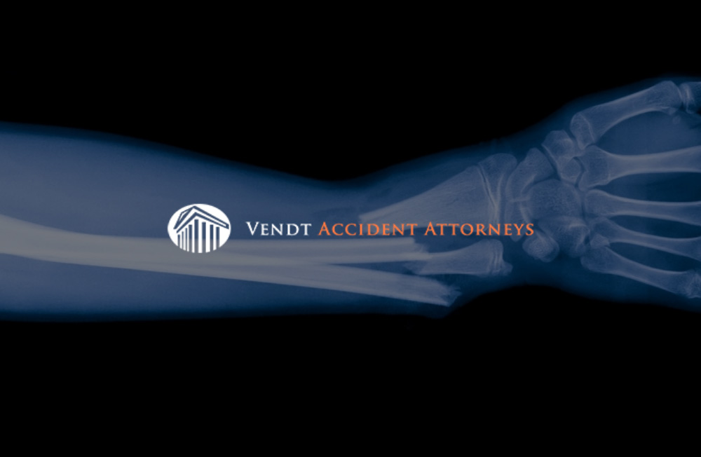 Richmond soft tissue injury lawyer